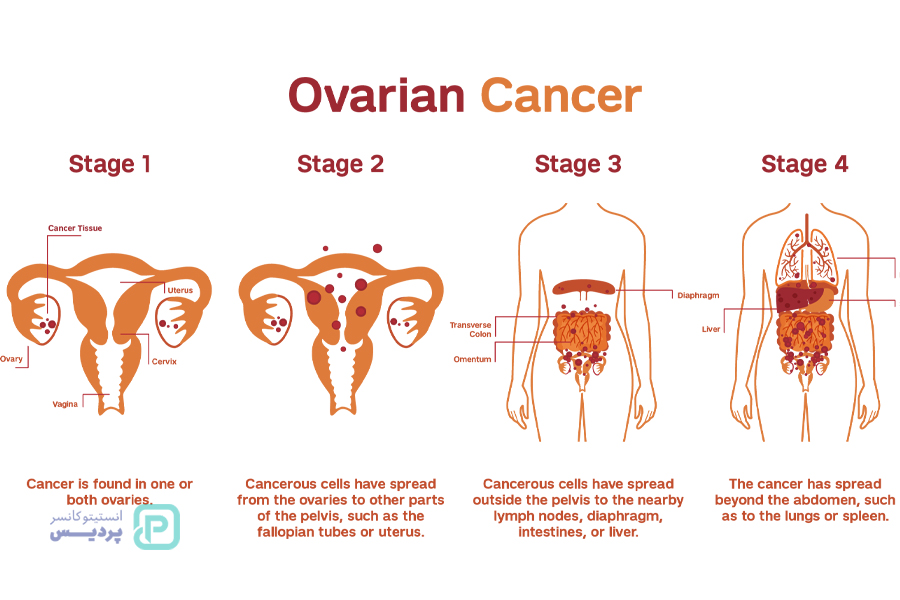 سرطان تخمدان چیست؟ تشخیص و علائم سرطان تخمدان 3 تشخیص سرطان تخمدان