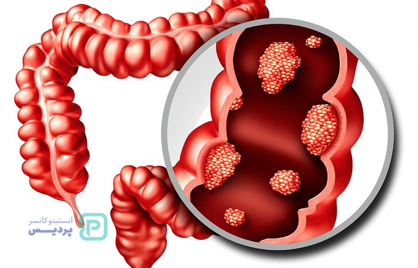شایع‌ترین سرطان‌های دستگاه گوارش - 4