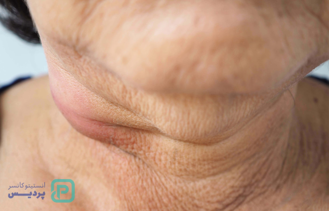 سرطان غده لنفاوی چیست؟ | علائم، انواع و روشهای درمان لنفوم 2 سرطان غده لنفاوی چیست؟ | علائم، انواع و روشهای درمان لنفوم - 2