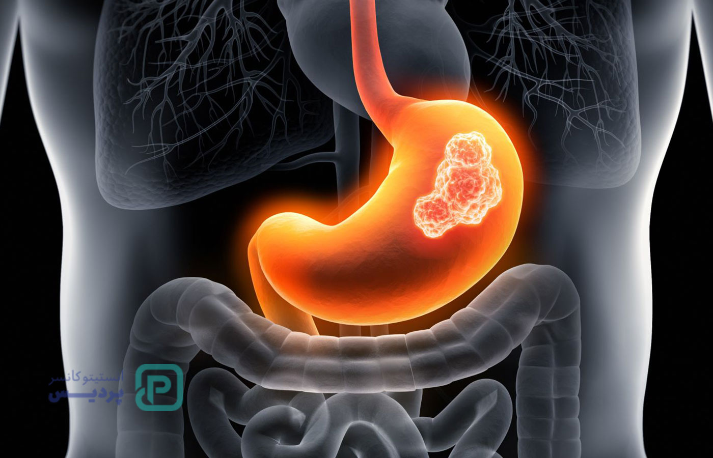 شایع‌ترین سرطان‌های دستگاه گوارش - 2