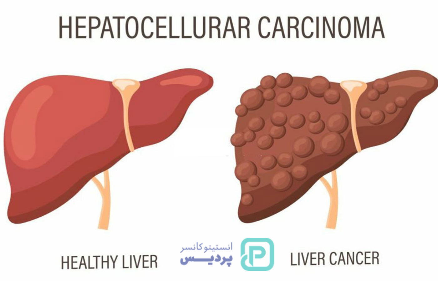 سرطان کبد؛ علائم، علل، روش‌های درمان و پیشگیری - 4