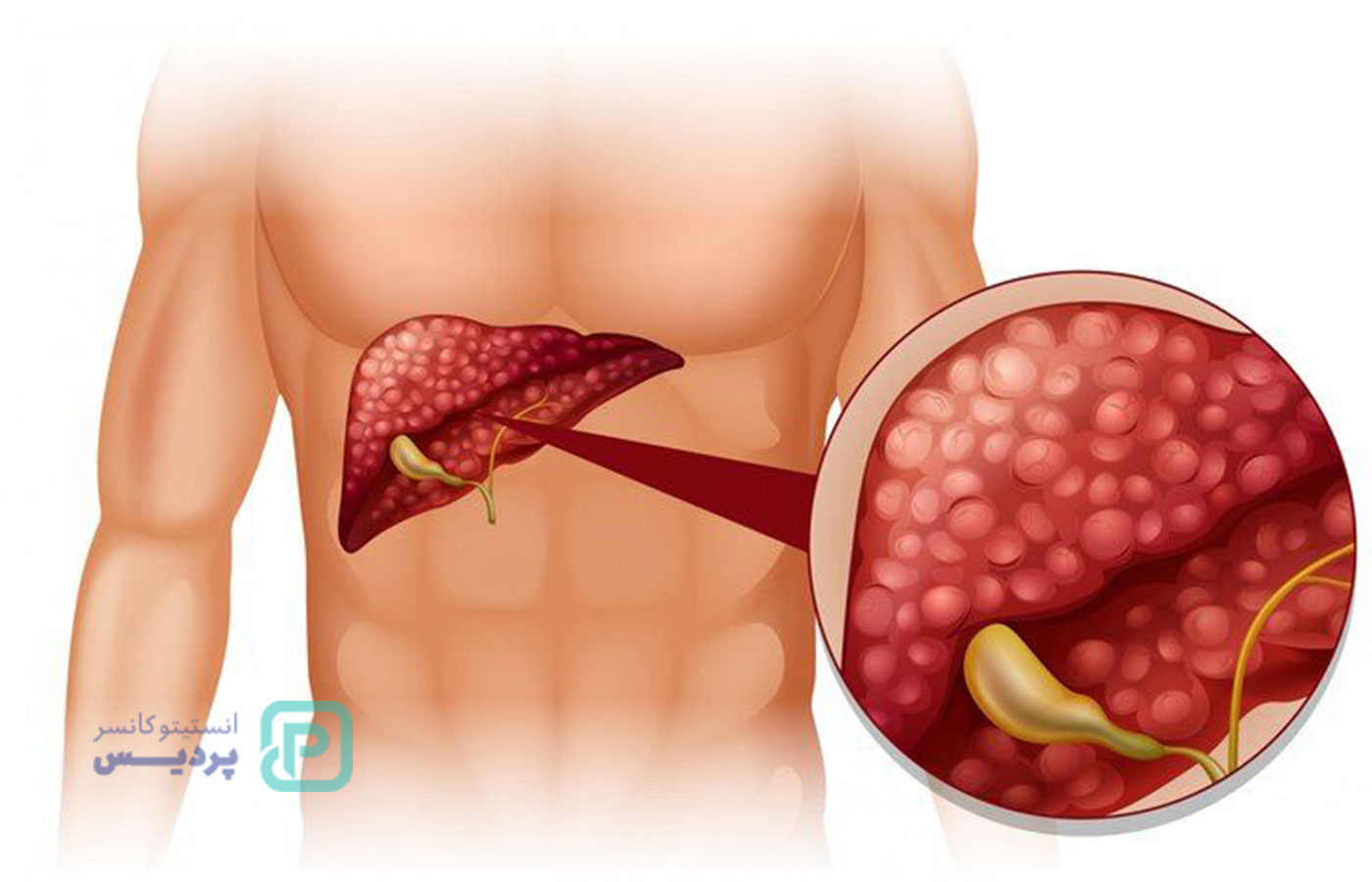 شایع‌ترین سرطان‌های دستگاه گوارش - 3