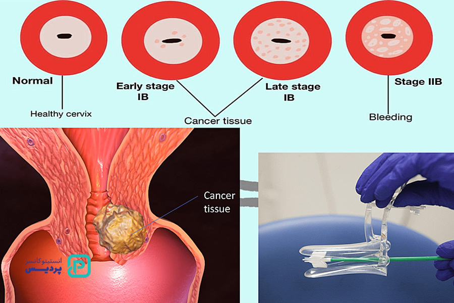 عوامل افزاینده خطر ابتلا به سرطان دهانه رحم