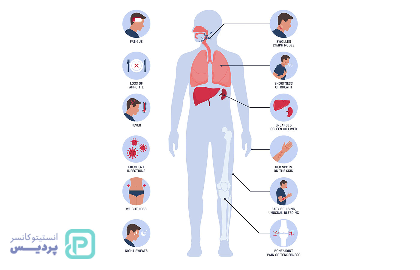 سرطان غده لنفاوی چیست؟ | علائم، انواع و روشهای درمان لنفوم 4 سرطان غده لنفاوی چیست؟ | علائم، انواع و روشهای درمان لنفوم - 4