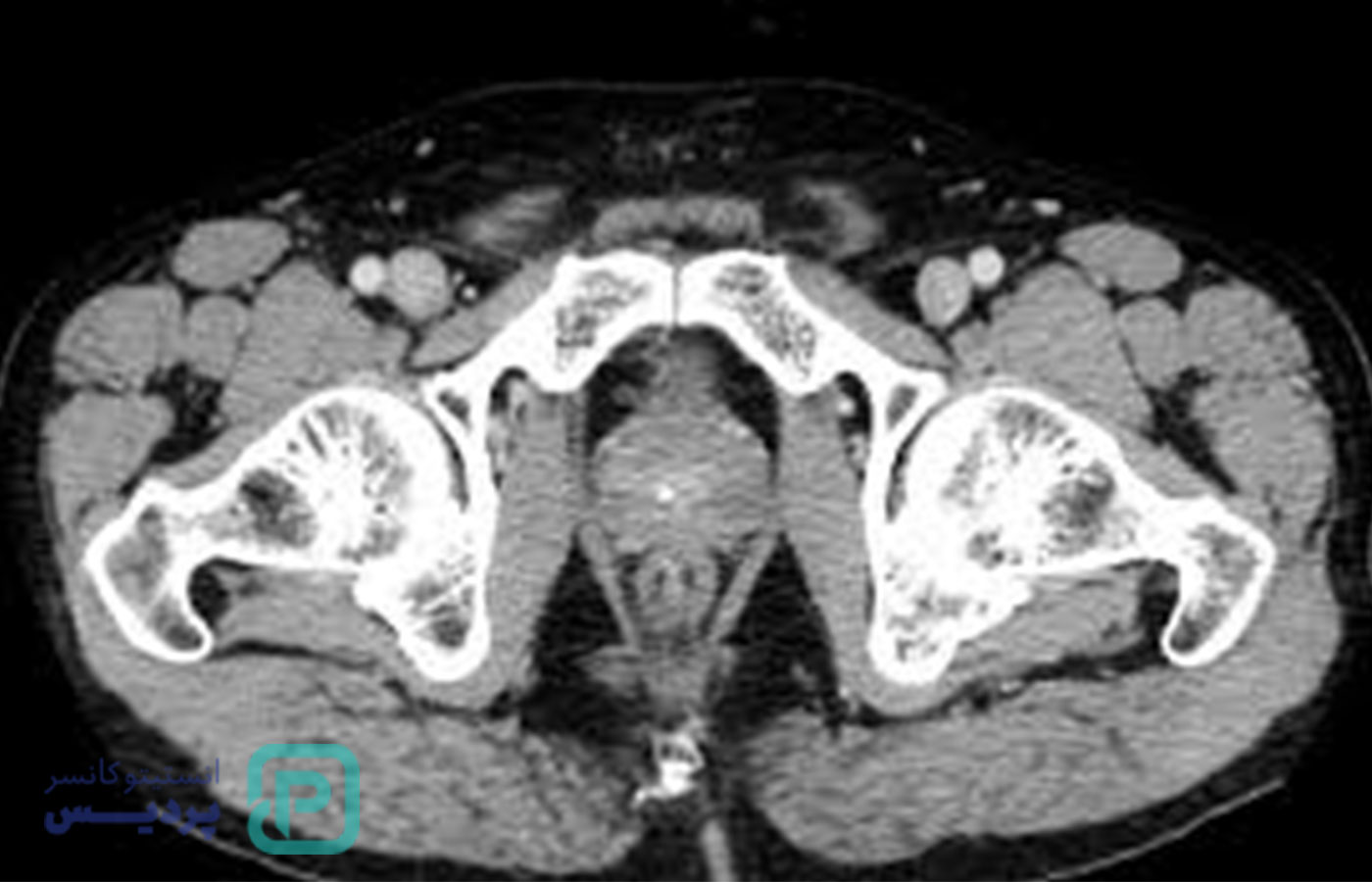 سونوگرافی پروستات چیست و چرا انجام میشود؟ 4 سونوگرافی پروستات چیست و چرا انجام میشود؟ - 4