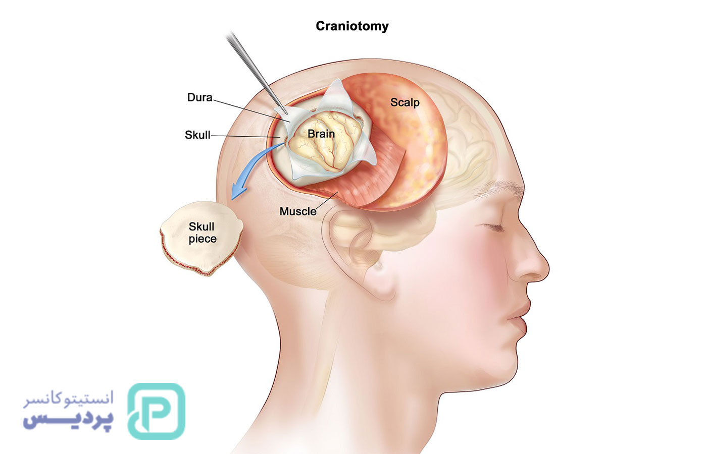 همه چیز درباره تومور مغزی: از نشانه‌ها تا درمان‌های نوین - 62
