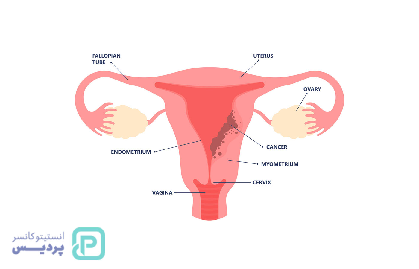 علائم سرطان رحم: نشانههایی که هر زنی باید بشناسد 2 علائم سرطان رحم: نشانههایی که هر زنی باید بشناسد - 2
