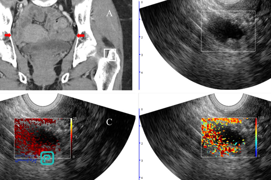 سرطان تخمدان را بیشتر بشناسید 5 انواع سرطان تخمدان