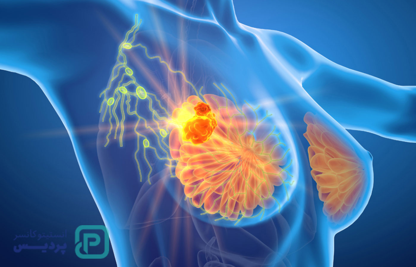 متاستاز چیست؟ همه چیز درباره گسترش سرطان به زبان ساده - 2