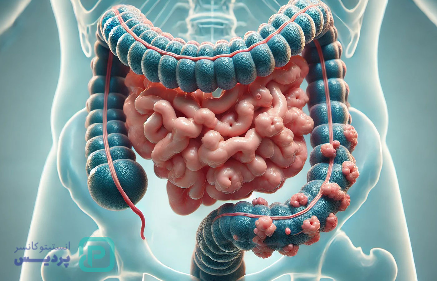 پولیپ روده چیست