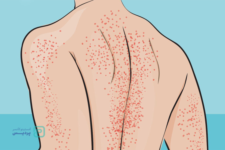 پایین بودن پلاکت خون: نشانه سرطان است؟ علائم، علتها و روشهای درمان 2 کم بودن پلاکت خون و سرطان