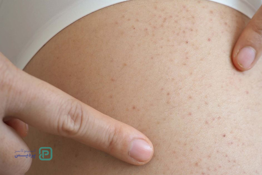 پایین بودن پلاکت خون: نشانه سرطان است؟ علائم، علتها و روشهای درمان 3 آیا پایین بودن پلاکت خون نشانه سرطان است؟