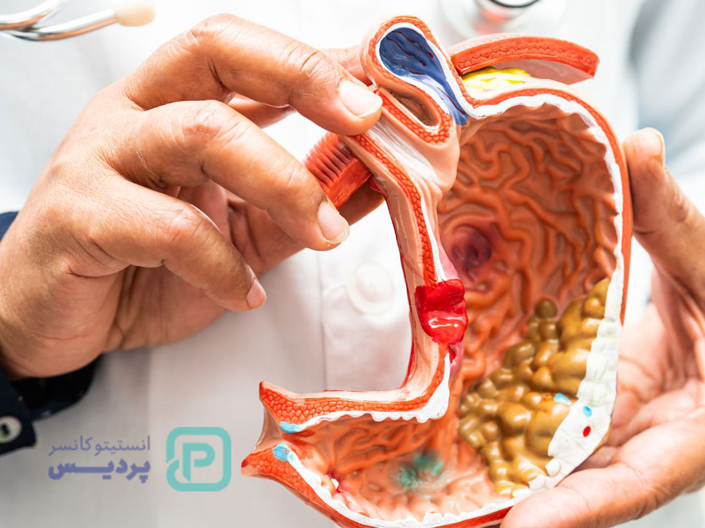 تست سرطان معده در منزل؛ واقعیت یا شایعه؟ 1 تست سرطان معده در منزل