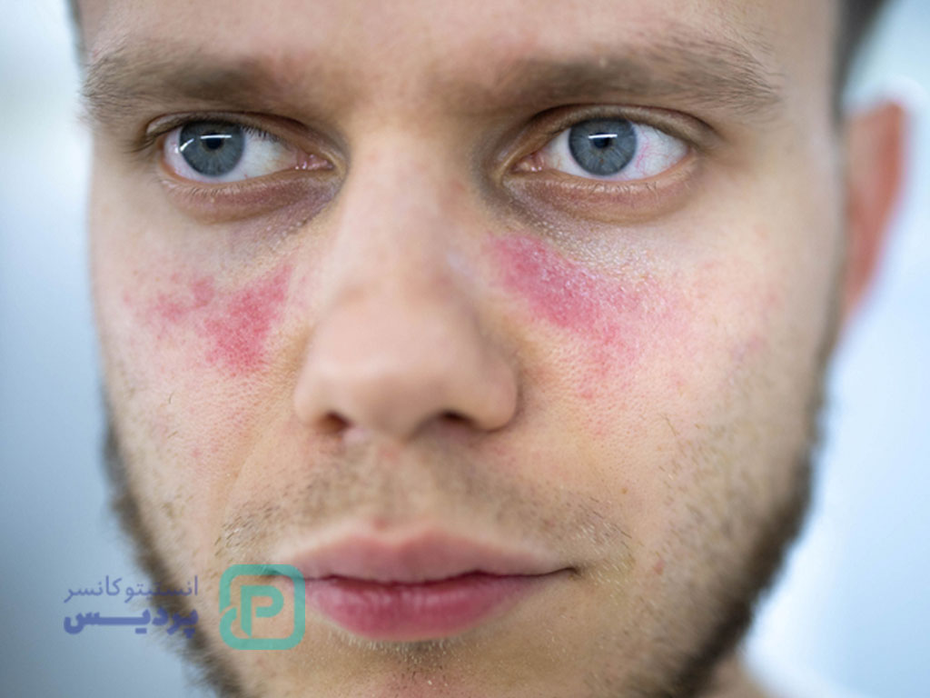 خطرناک‌ترین بیماری خودایمنی-12