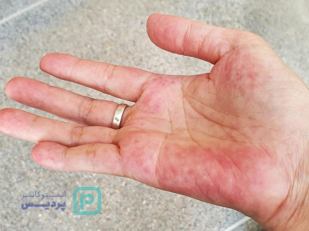 خطرناک‌ترین بیماری خودایمنی-2