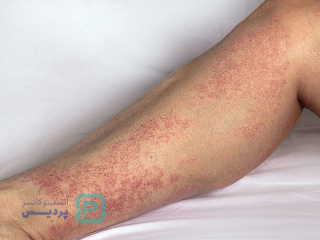 خطرناک‌ترین بیماری خودایمنی-3