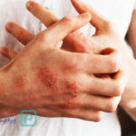 خطرناک‌ترین بیماری خودایمنی-عکس شاخص