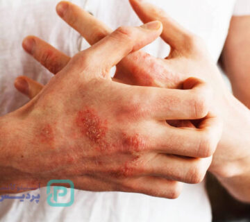 خطرناک‌ترین بیماری خودایمنی-عکس شاخص