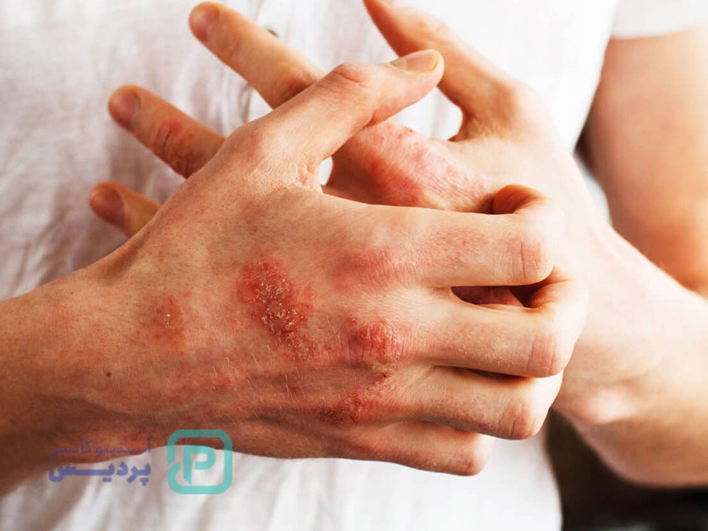 خطرناک‌ترین بیماری خودایمنی-عکس شاخص