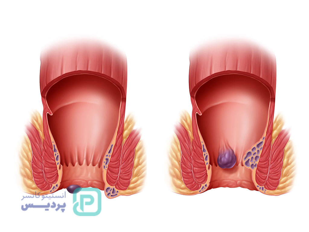 علت خونریزی هنگام دفع مدفوع بدون درد؛ آیا باید نگران باشیم؟ 2 خونریزی هنگام دفع مدفوع بدون درد-1