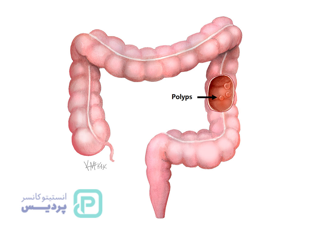 علت خونریزی هنگام دفع مدفوع بدون درد؛ آیا باید نگران باشیم؟ 4 خونریزی هنگام دفع مدفوع بدون درد-3