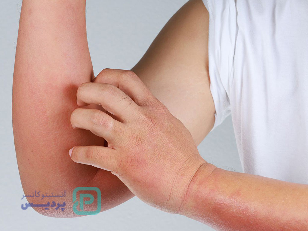 علائم سرطان کبد؛ نشانههای هشداردهنده را بشناسید 2 علائم سرطان کبد-2