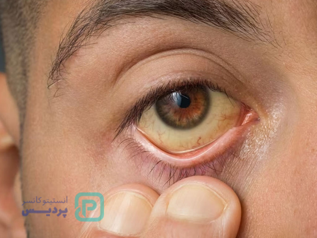 علائم سرطان کبد؛ نشانههای هشداردهنده را بشناسید 4 علائم سرطان کبد-4