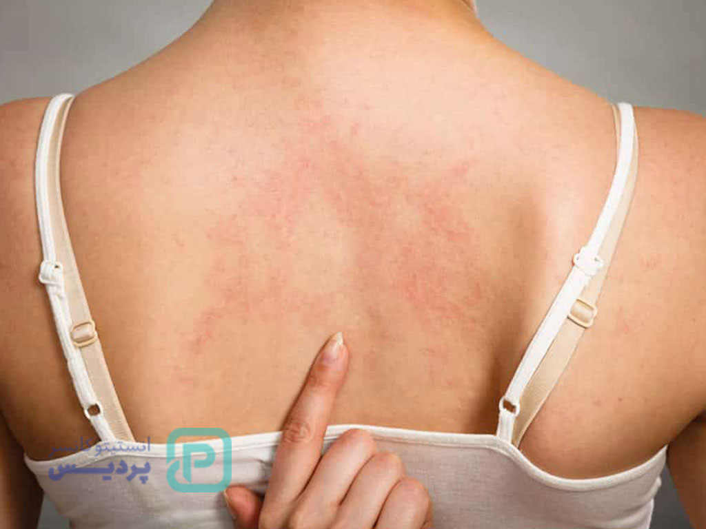 علائم سرطان کبد؛ نشانههای هشداردهنده را بشناسید 6 علائم سرطان کبد-7