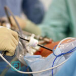 لاپاراسکوپی روده