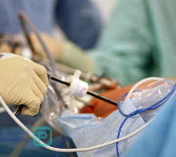 همه چیز درباره جراحی لاپاراسکوپی روده بزرگ 2 لاپاراسکوپی روده