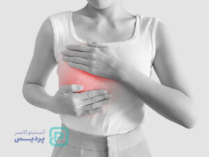 پاپیلوم سینه