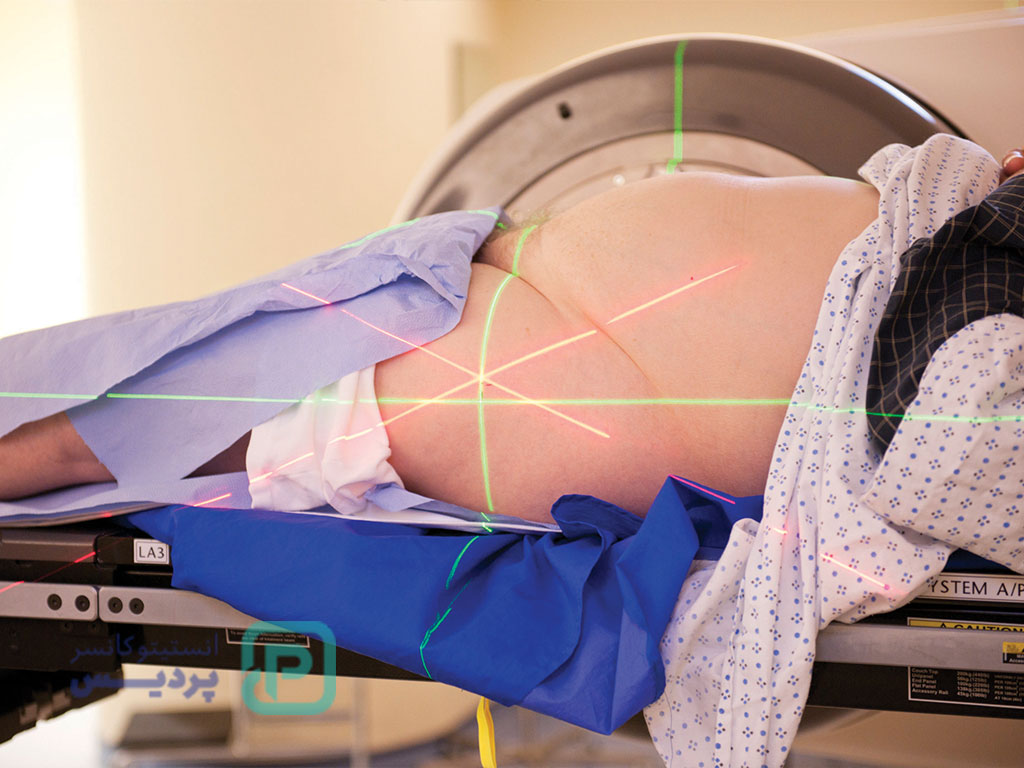 رادیوتراپی پروستات چقدر مؤثر است؟ 3 رادیوتراپی پروستات-1