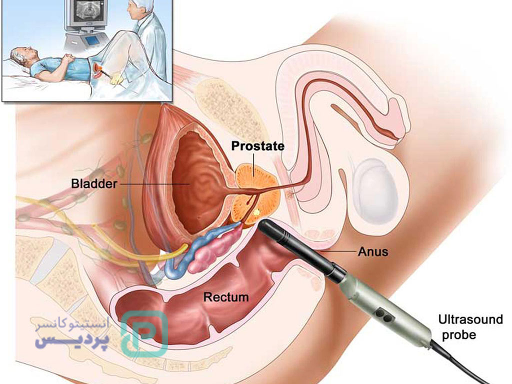رادیوتراپی پروستات چقدر مؤثر است؟ 6 رادیوتراپی پروستات-6
