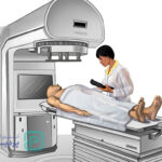 رادیوتراپی پروستات