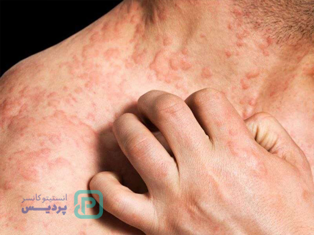 آیا اگزما سرطان است یا میتواند به سرطان تبدیل شود؟ 3 بیماری های مشابه به اگزما