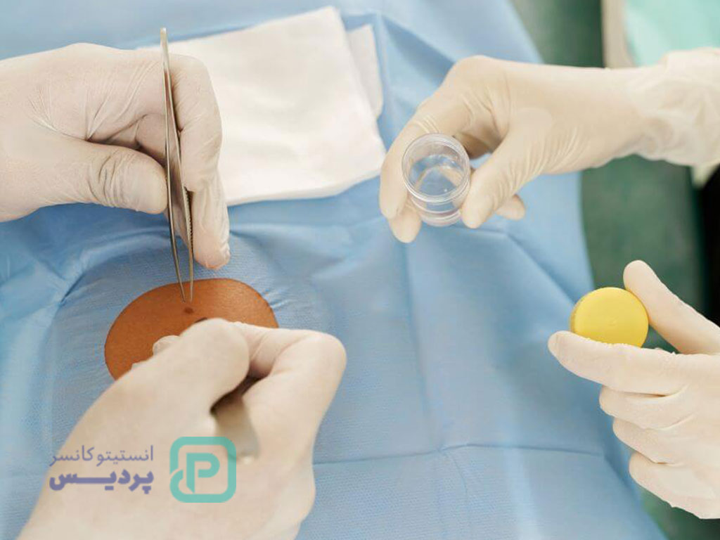 آیا اگزما سرطان است یا میتواند به سرطان تبدیل شود؟ 5 روش تشخیص اگزما