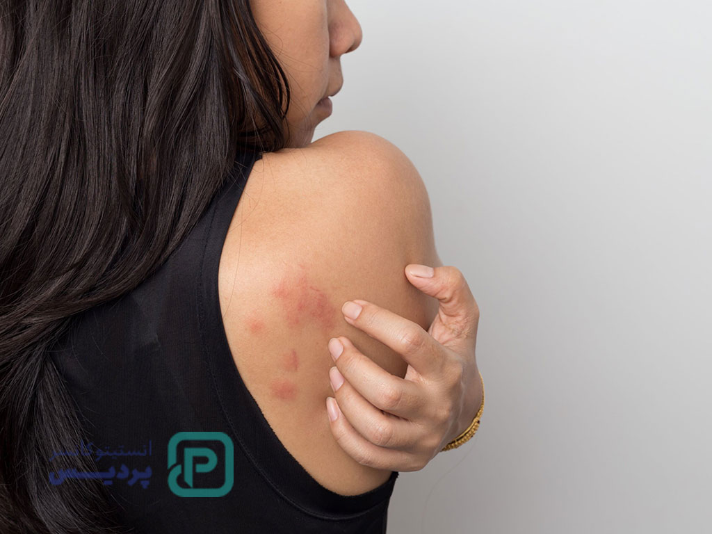 آیا اگزما سرطان است یا میتواند به سرطان تبدیل شود؟ 1 سرطان اگزما چیست