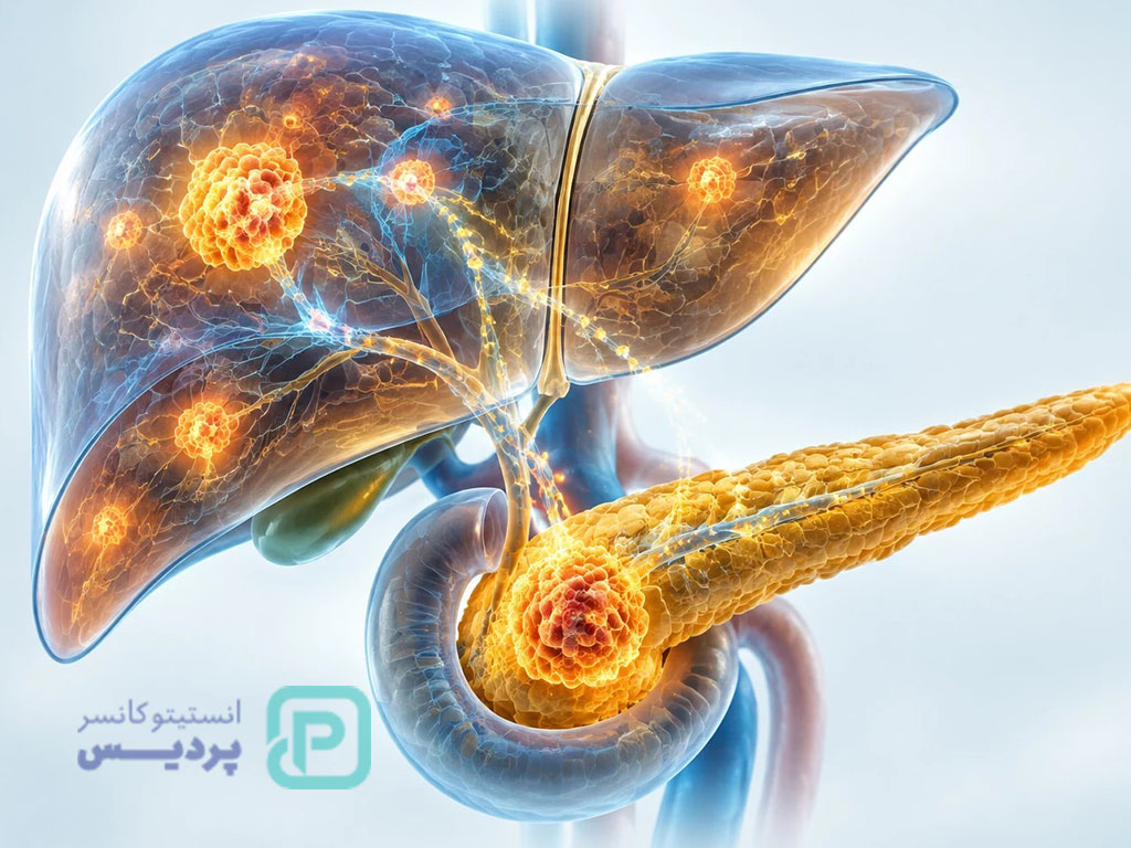 تشخیص و درمان سرطان پانکراس با متاستاز کبدی 1 سرطان پانکراس و متاستاز به کبد